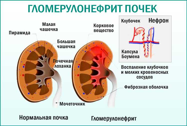 Гломерулонефрит клиническая картина