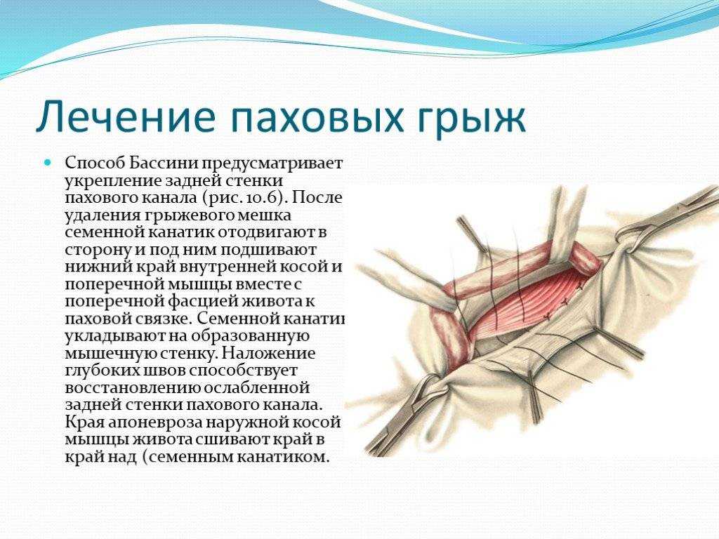 Ущемление паховой грыжи карта вызова