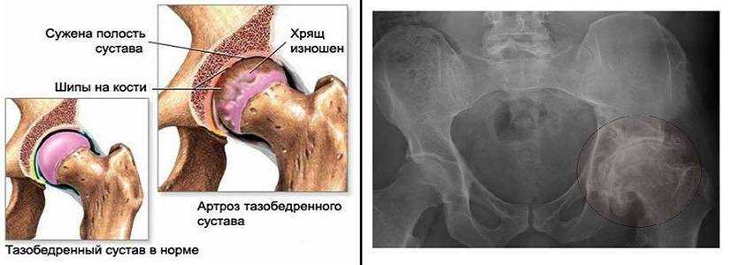 Схема лечения коксартроза тазобедренного сустава 2 степени