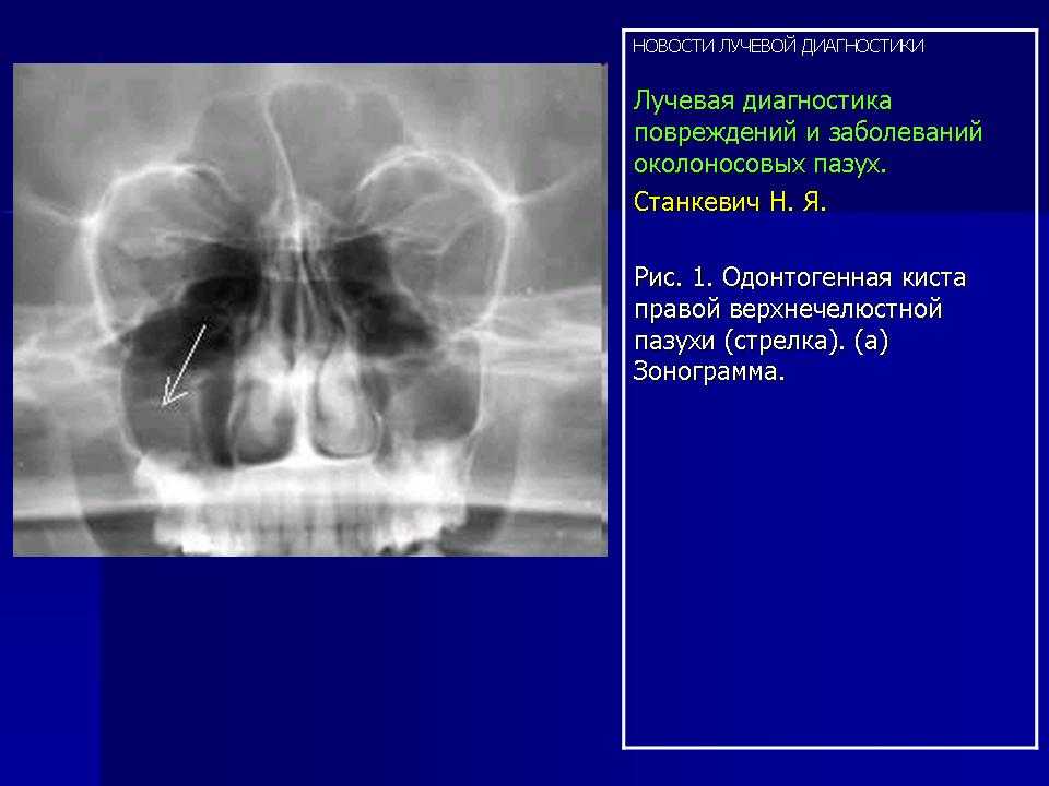 Заболевания придаточных пазух носа. Лучевая диагностика ППН. Рентгеноанатомия придаточных пазух. Диагностика заболеваний околоносовых пазух.