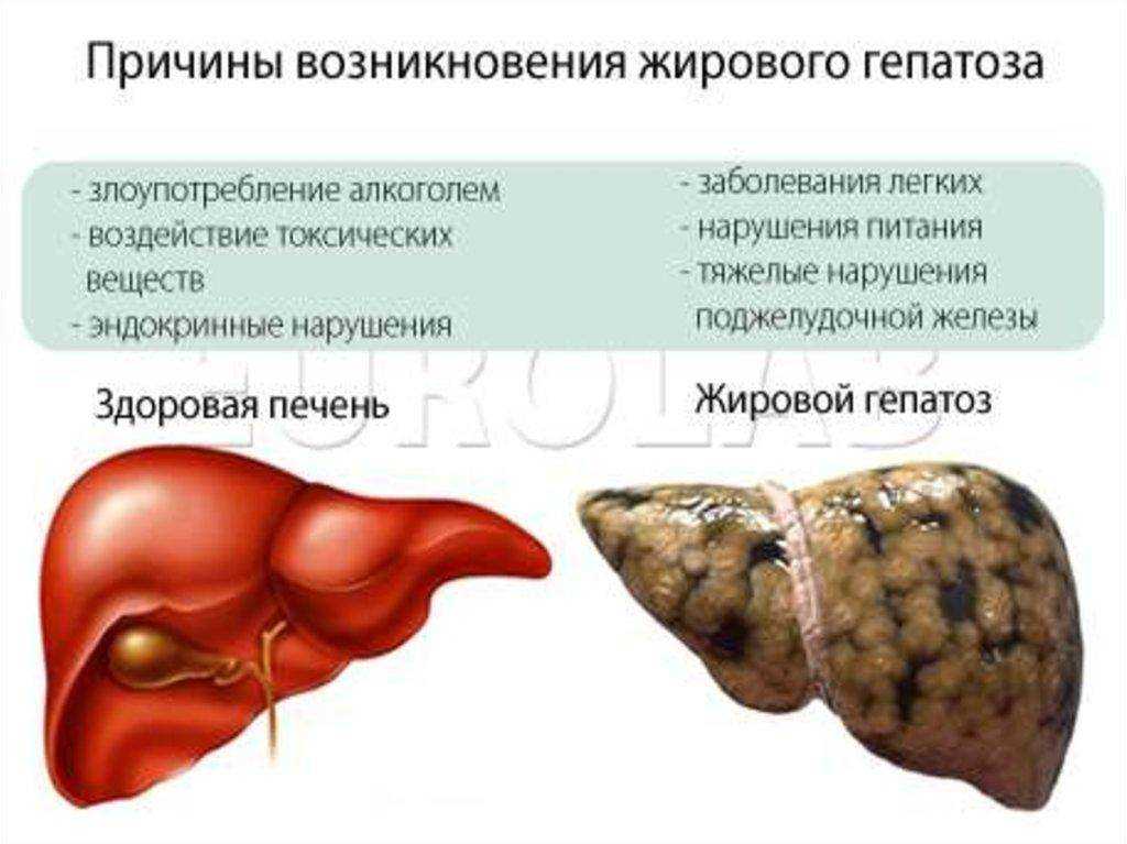 Печень терапия. Жирового гепатоза печени. Причины жирового перерождения печени. Ожирение печени гепатоз печени. Жировая дистрофия печени(жировой гепатоз).