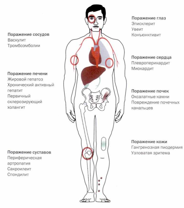 Клиническая картина болезни крона