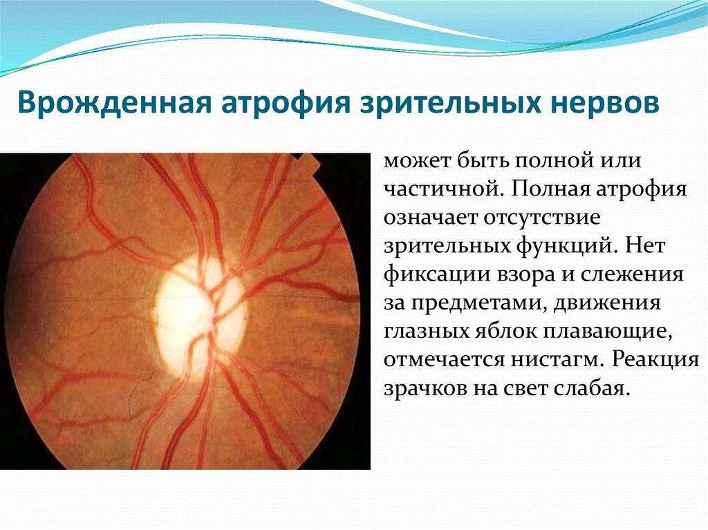 Поражение зрительного. Атрофия зрительного нерва клинические проявления. Врождённая частичная атрофия зрительного нерва. Патогенез атрофии зрительного нерва. Атрофия зрительного нерва Лебера клиника.
