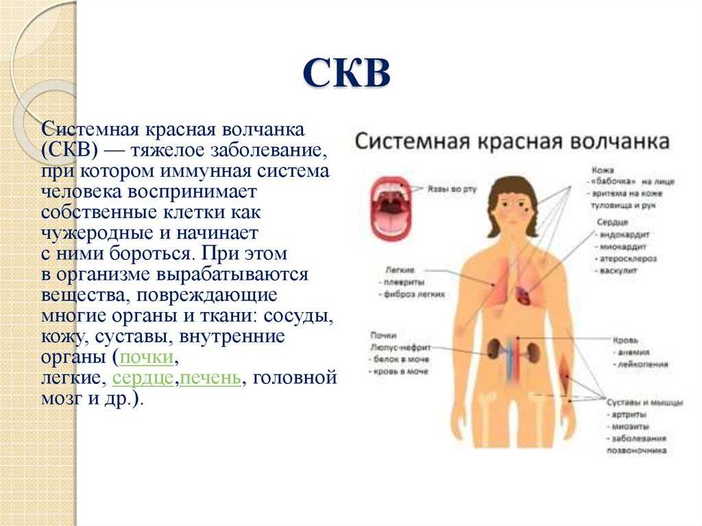 Системная красная волчанка (скв)