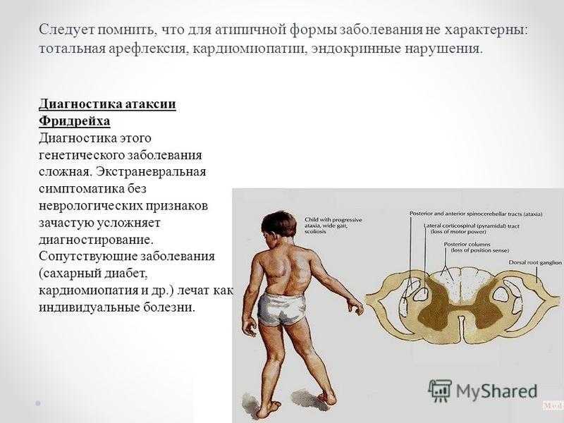 Атаксия фридрейха - наследственная природа болезни, симптомы и лечение