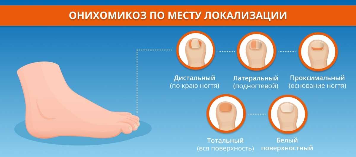 Что такое микоз?