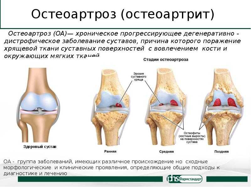Артрит суставов: симптомы и лечение – напоправку – напоправку
