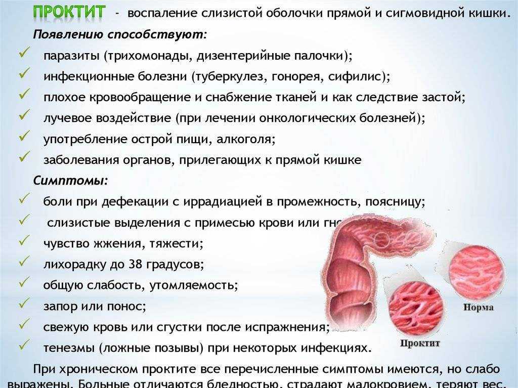 Проктит: симптомы и лечение воспаления прямой кишки - medside.ru