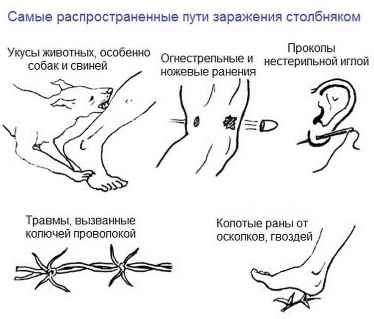 Столбняк: инкубационный период и симптомы у человека