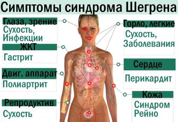 Синдром шегрена: причины, симптомы и лечение