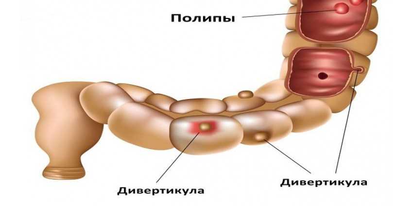 Дивертикул кишечника картинки