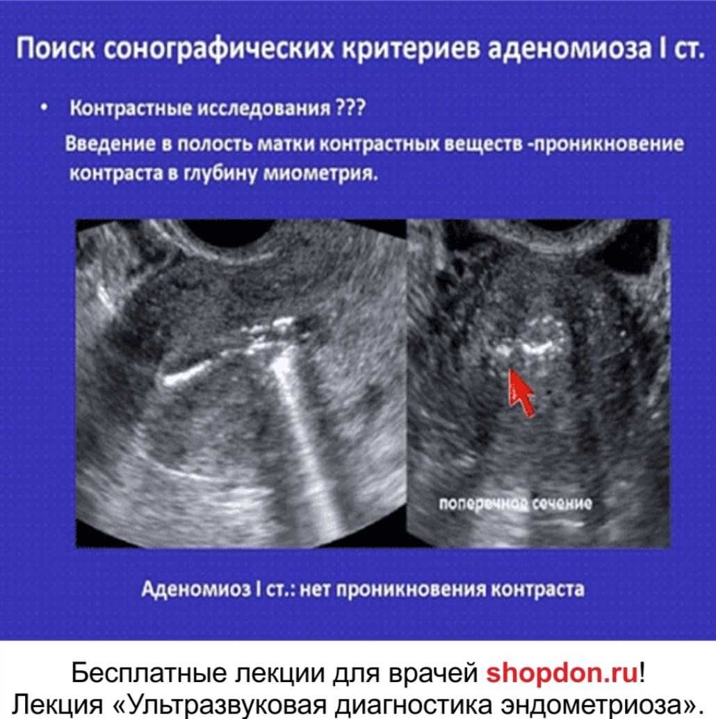 Узи признаки эндометриоза матки. Диагностические критерии аденомиоза. Диффузная форма аденомиоза 3 степени.