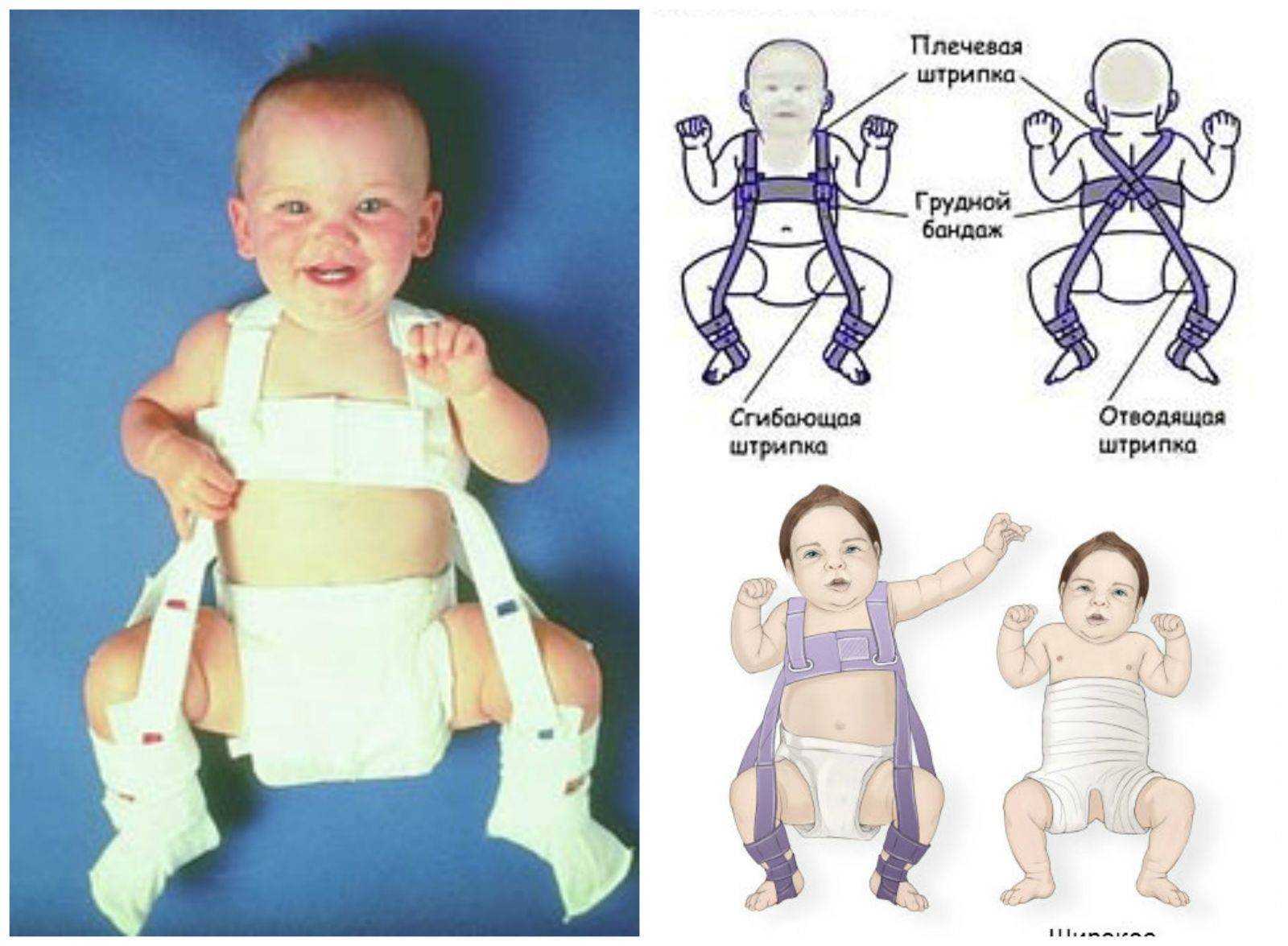 Отводящая защита. 2х сторонняя дисплазия тазобедренных суставов. Нелеченная дисплазия тазобедренных суставов у детей. Дисплазия тазобедренных суставов у ребенка до 1 года. Дисплазия тазобедренных суставов у ребенка 3 месяца.