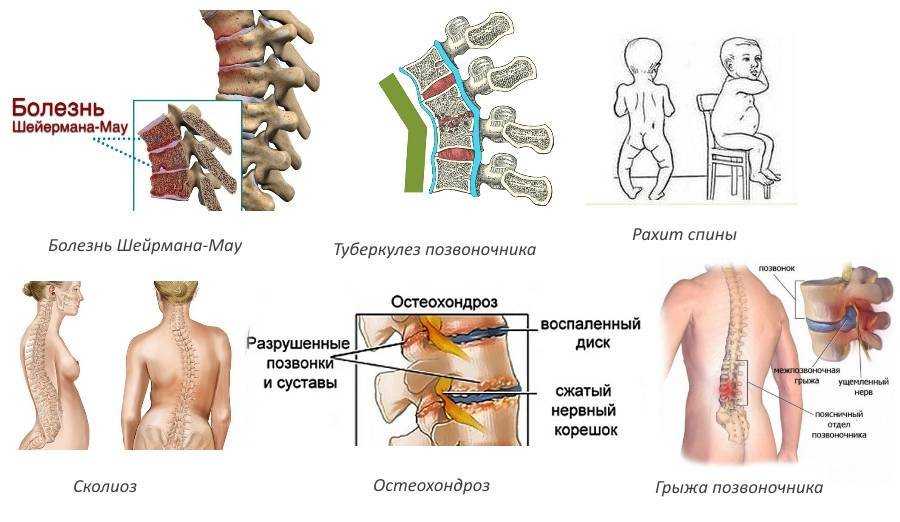 Искривление позвоночника шейермана мау