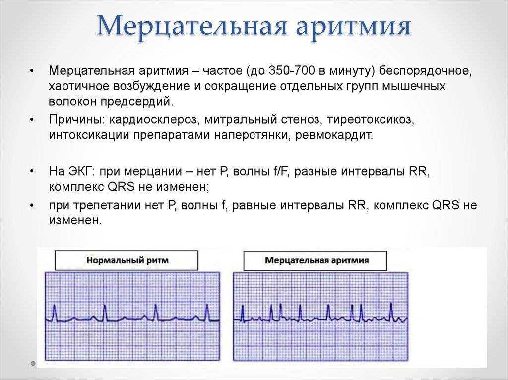 Фибрилляция предсердий картинки