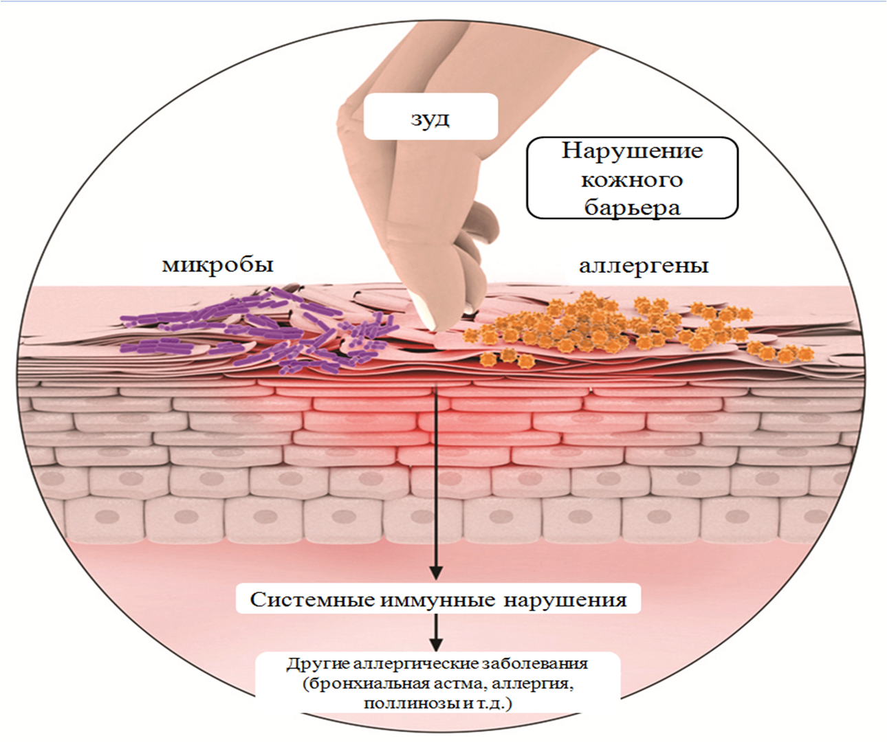 Причины нарушения кожи. Атопический дерматит строение кожи. Атопического дерматита (нейродермита). Атопический дерматит лихенификация. Атопический дерматит схема.