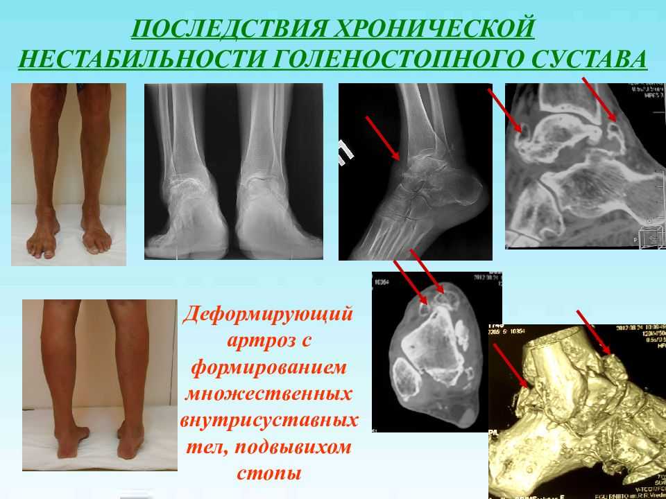 Болезни связок, мышц и сухожилий — заболевания, симптомы и лечение в gms hospital