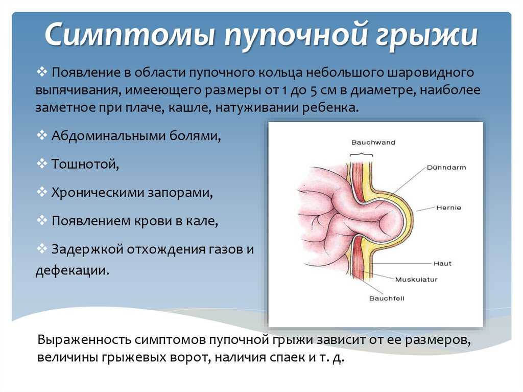 Пупочная грыжа карта смп