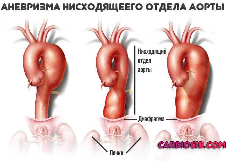 Симптомы и лечение аневризмы грудной аорты - medside.ru