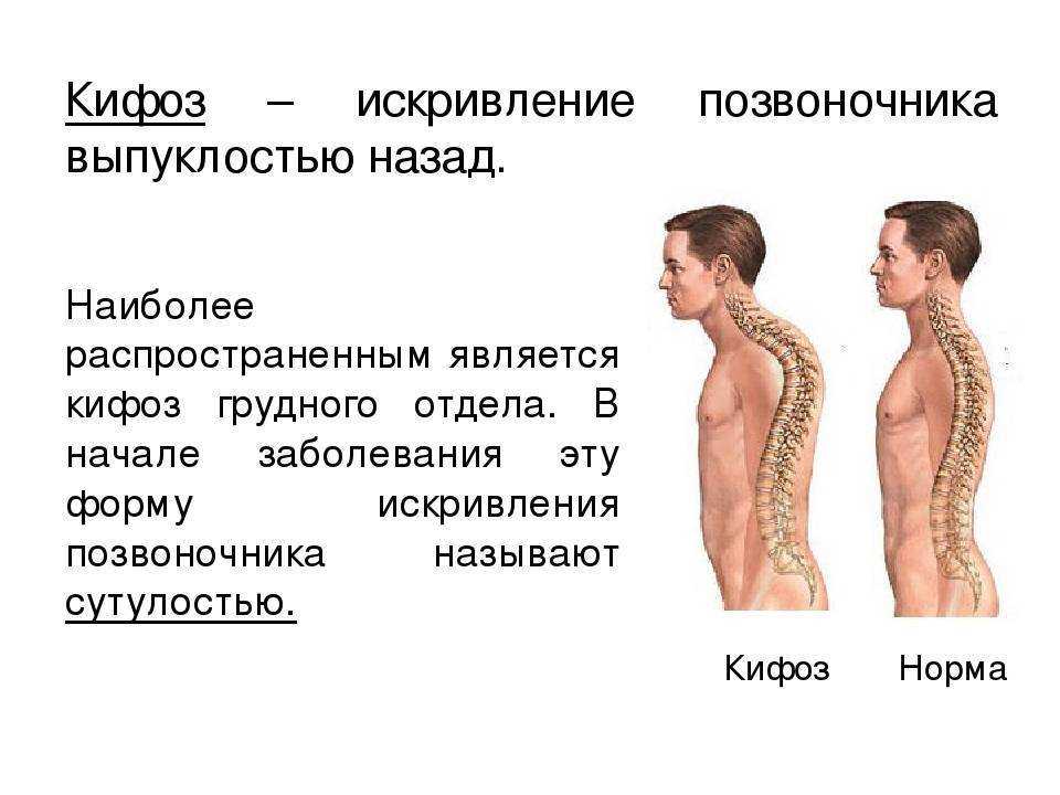 Лордоз кифоз картинки