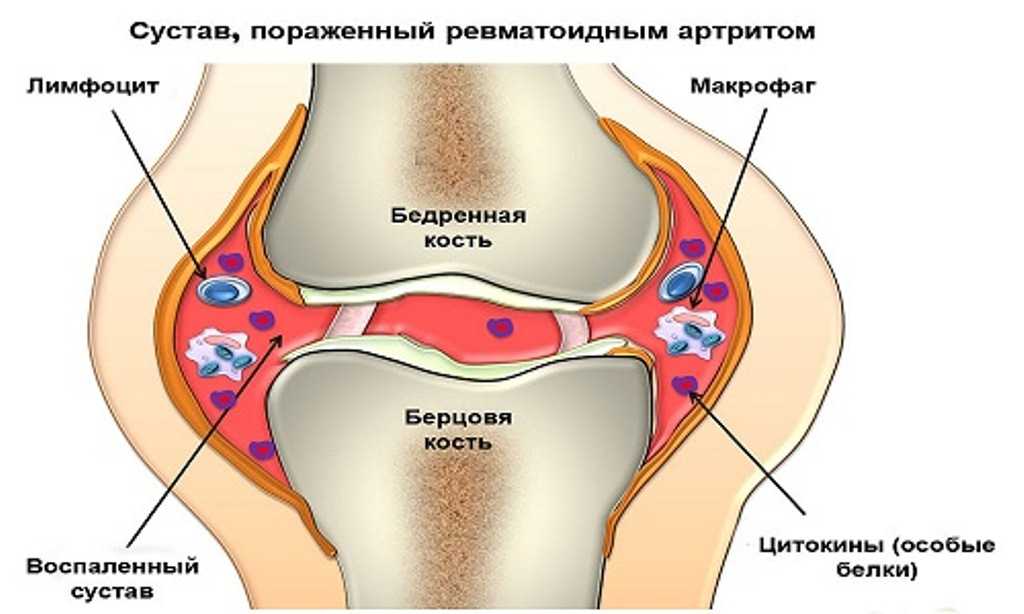 Клиническая картина артрита