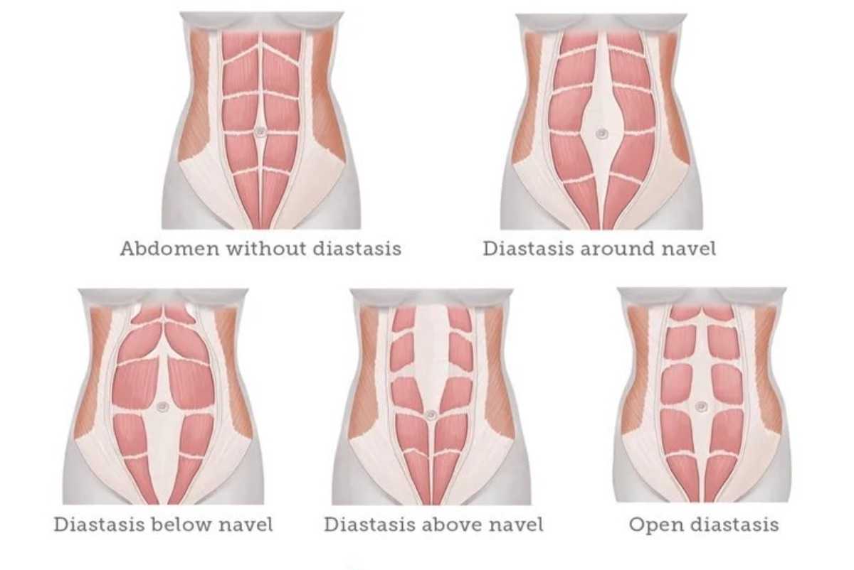 Болят мышцы живота причины. Диастаз брюшной стенки. Мышцы живота анатомия диастаз. Диастаз прямой мышцы беременность.
