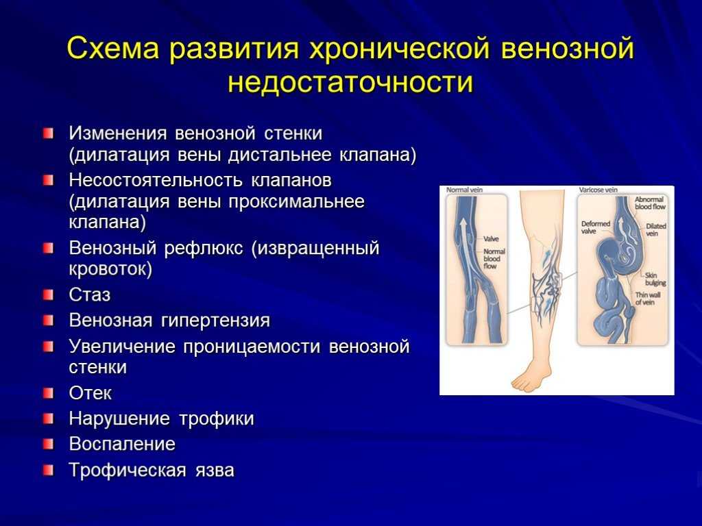 Заболевания вен