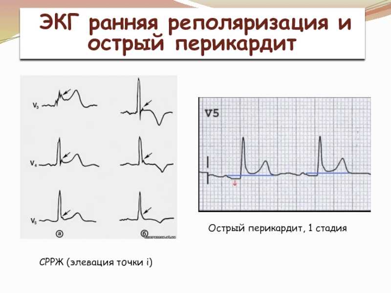 Синдром и феномен укороченного интервала pq на экг: причины, диагностика, проявления, когда и как лечить