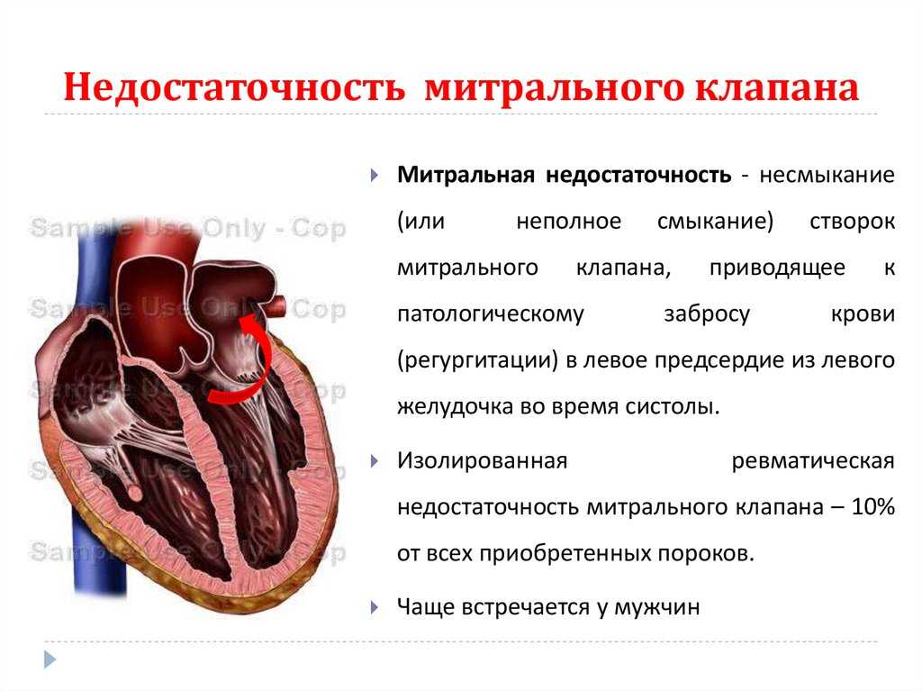 Недостаточность митрального клапана 1,2 и 3 степени: лечение и прогноз - medside.ru