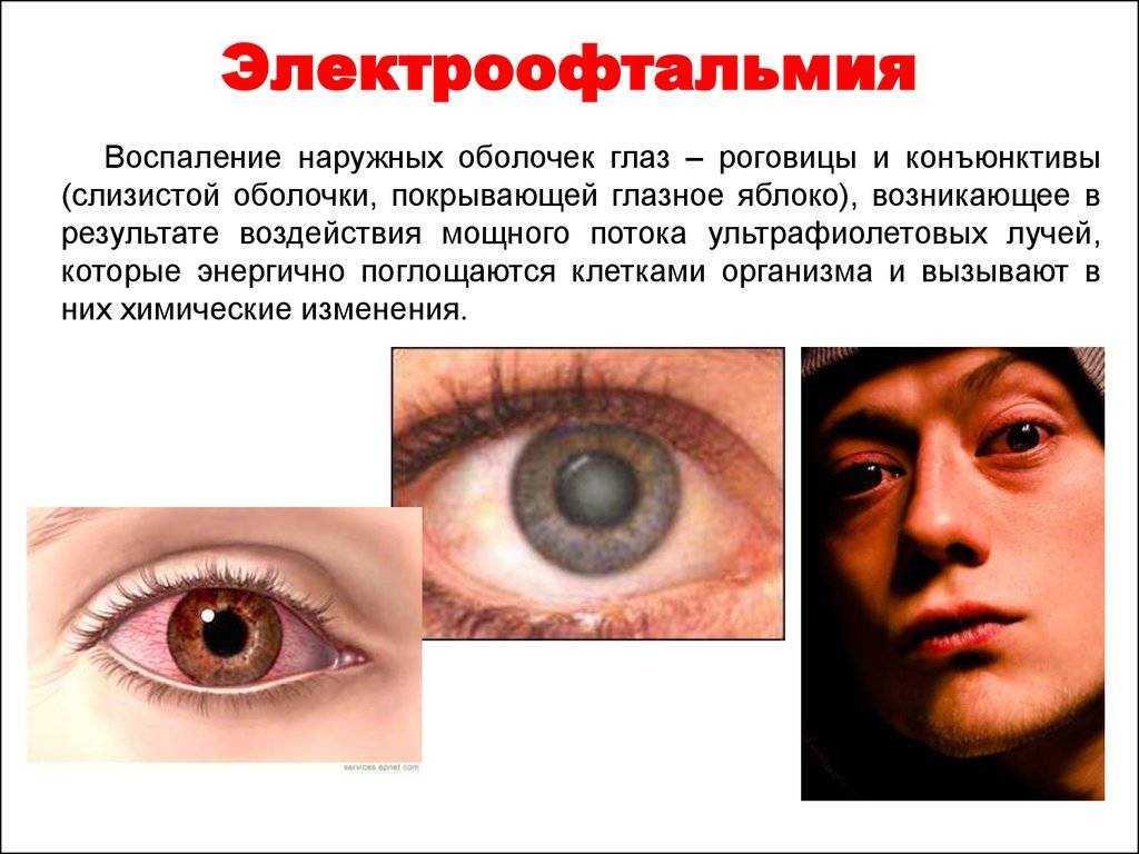 Заболевание Глаз Картинки