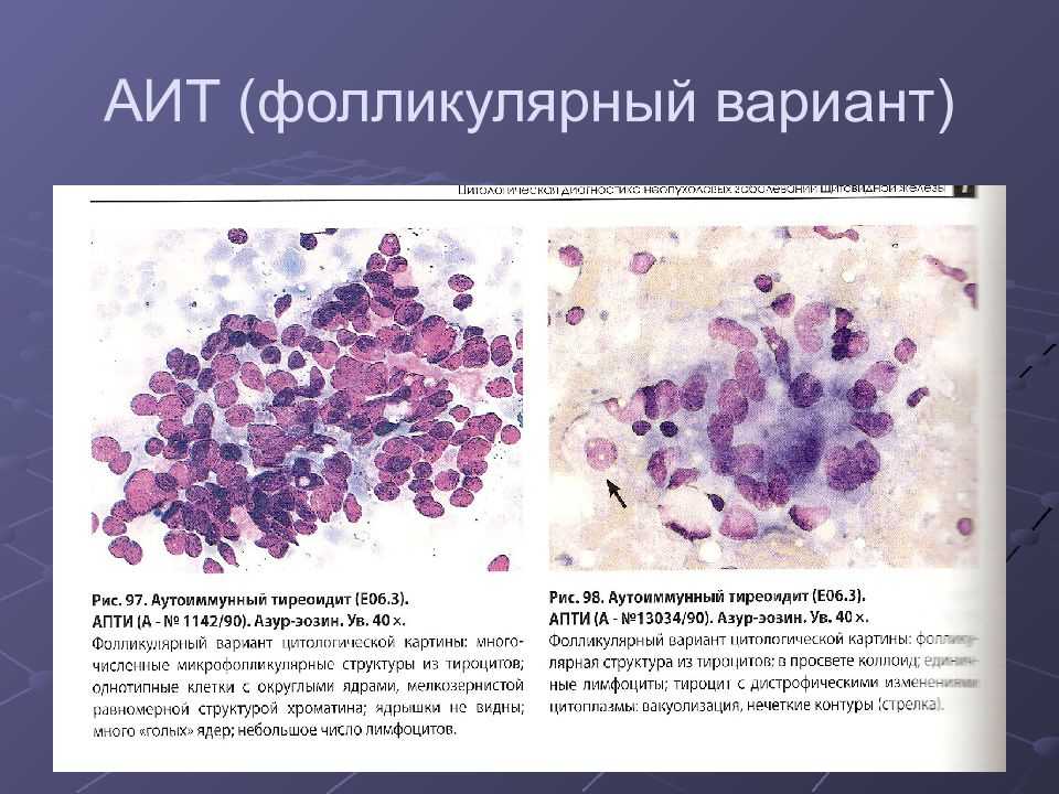 Атипия развития. Фолликулярная аденома щитовидной железы цитология. Аутоиммунный тиреоидит Хашимото микропрепарат патанатомия. Аутоиммунный тиреоидит цитологическая картина.