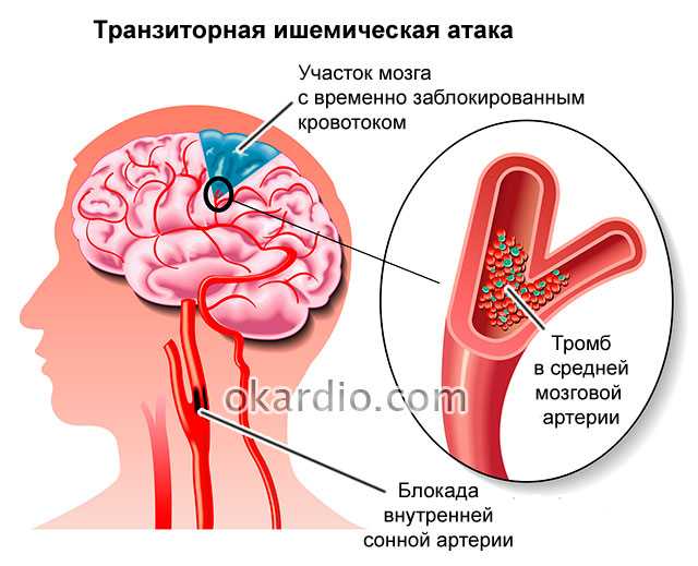 Этиология, патогенез, клиническая диагностика, дифференциальная диагностика и лечение острых нарушений мозгового кровообращения