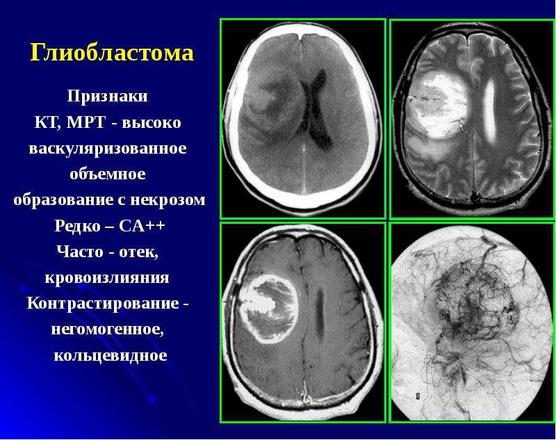 Мр признаки. Компьютерная томография головного мозга опухоль. Глиобластома на кт на кт. Глиобластома головного мозга на кт. Глиобластома головного мозга на кт и мрт.