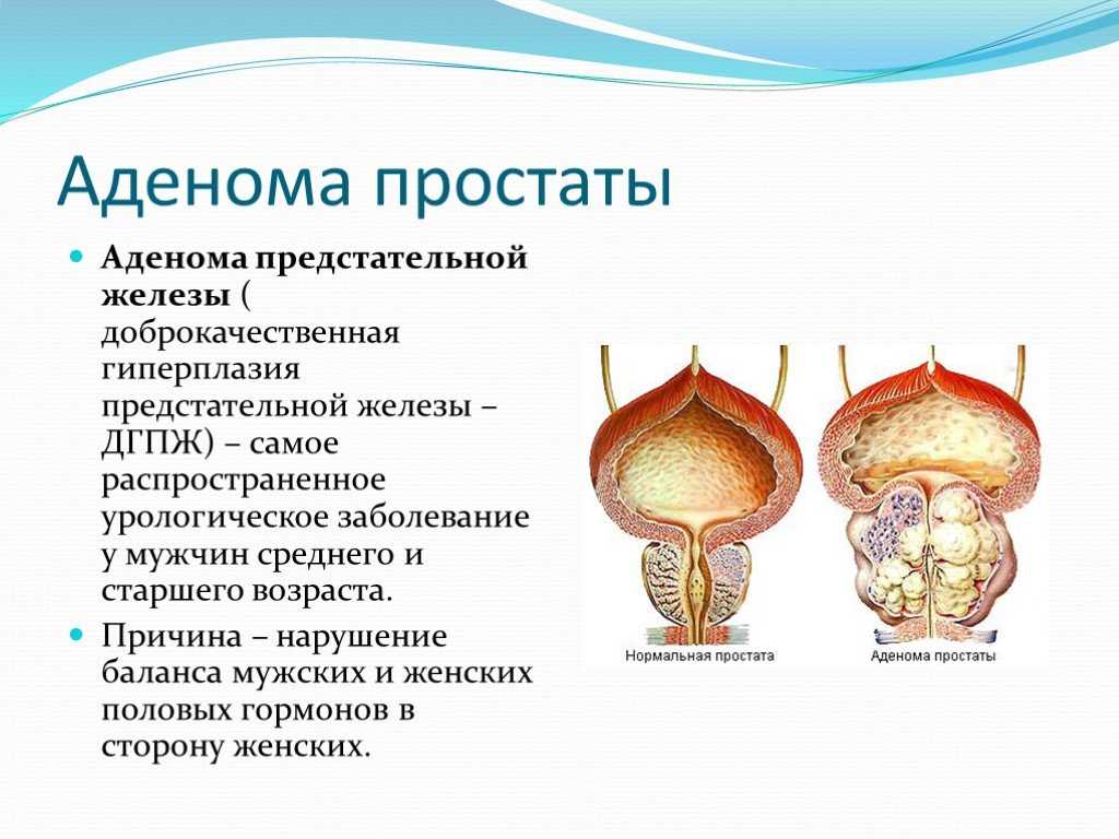 Аденома простаты схема лечения