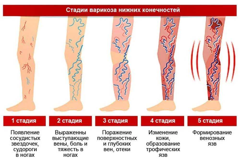 Тромбофлебит нижних конечностей лечение препараты схема лечения симптомы у женщин после 60 лет