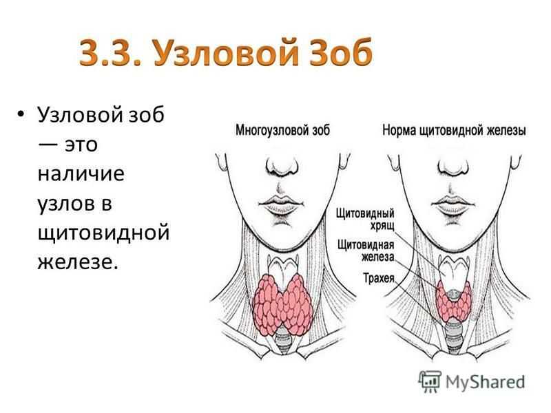 Где находится щитовидка у мужчин схема симптомы