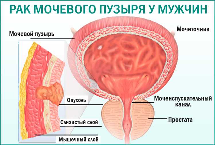 Рак мочевого у мужчин лечение