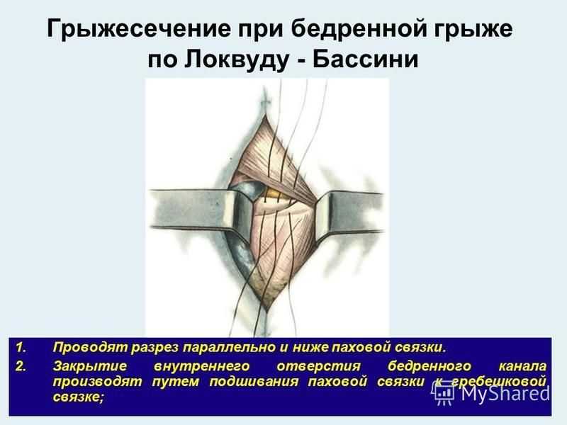 Бедренный способ. Операция по Бассини при бедренной грыже. Бедренная грыжа способ Бассини. Операция Бассини при бедренных грыжах. Бедренная грыжа операция по Бассини.