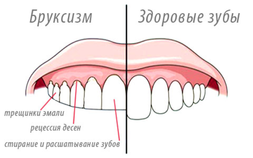 Зубы стучат что значит. Бруксизм у взрослых причины.