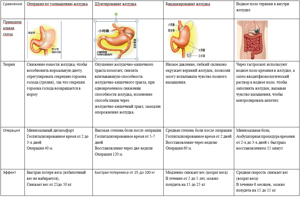 Продольная резекция желудка фото