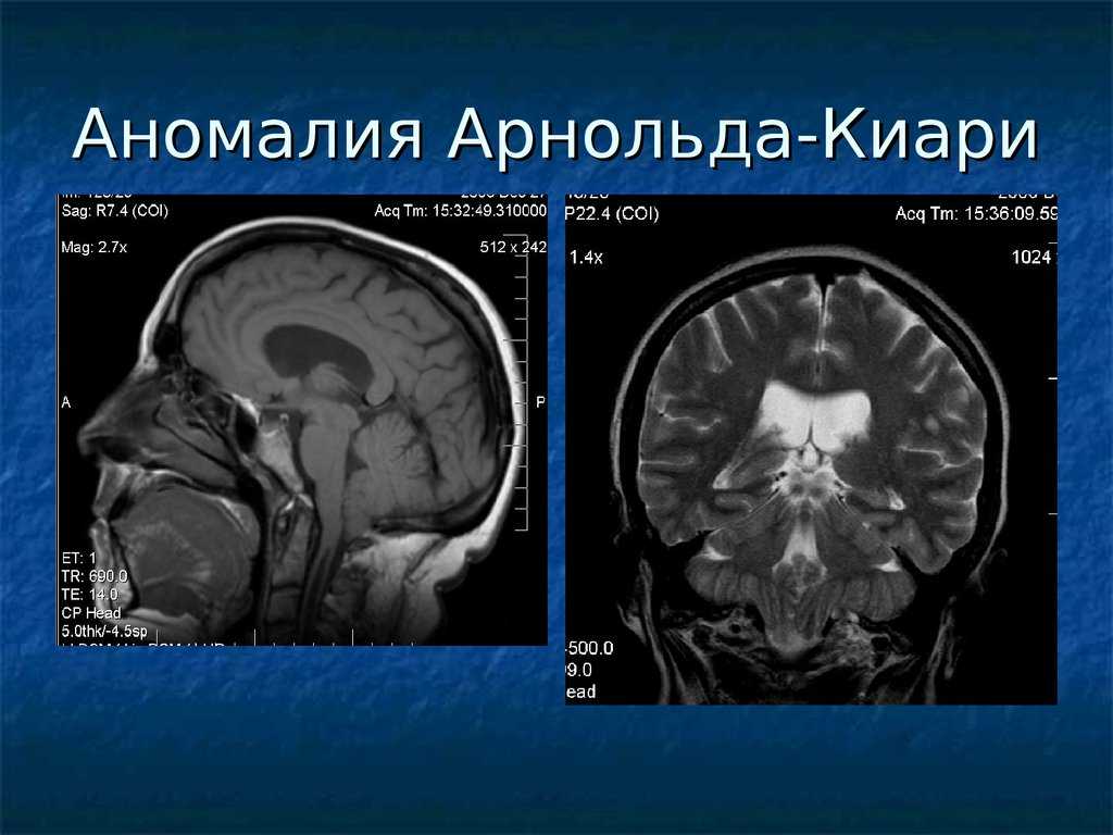 Пара аномалия. Арнольда Киари мрт степени. Аномалия Арнольда Киари 1 типа мрт головного мозга. Аномалия Арнольда Киари мрт. Аномалия Арнольда-Киари 1-2 Тип.