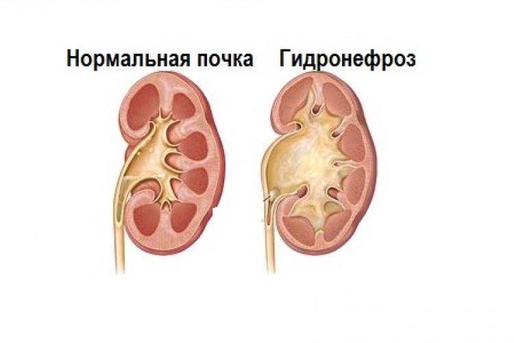 Гидронефроз почек