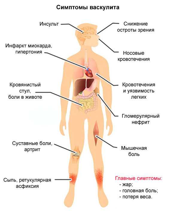 Шенлейна-геноха болезнь
