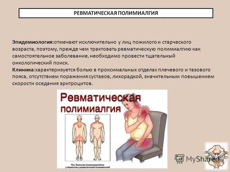 Миалгия симптомы у взрослых