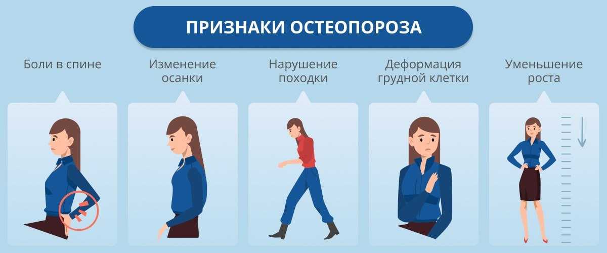 Несовершенный остеогенез