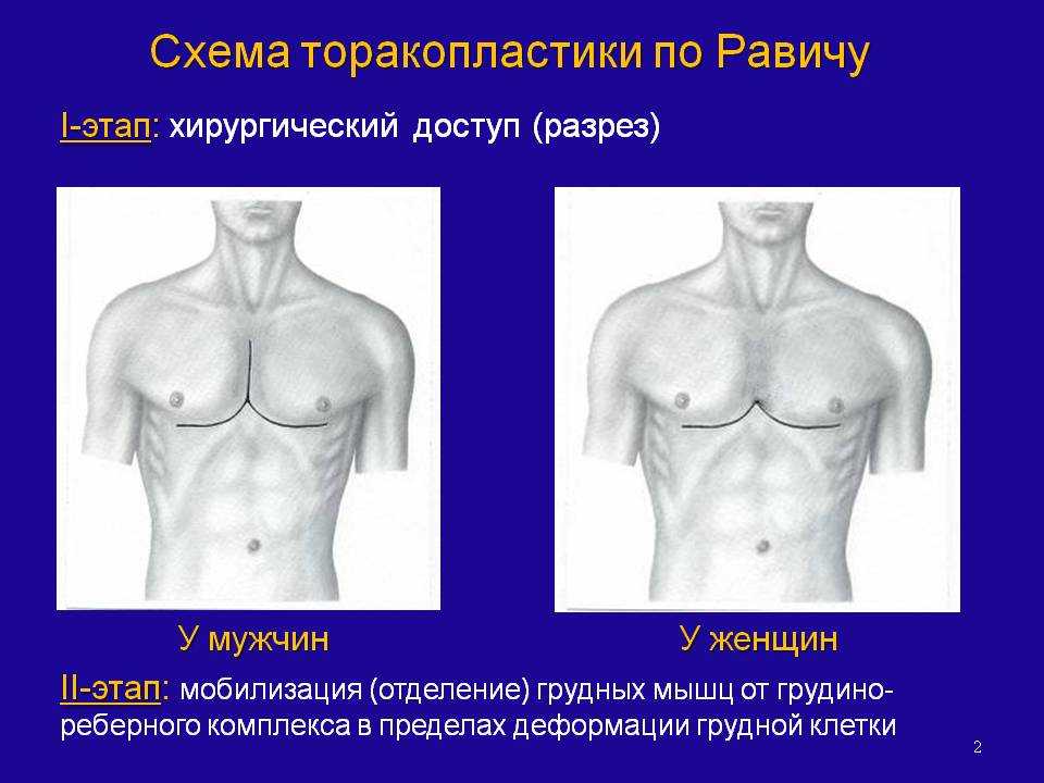 Деформация грудной клетки