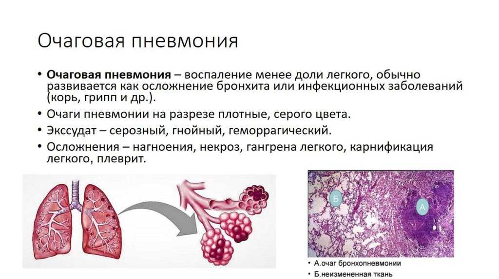 Неспецифические воспалительные заболевания дыхательных путей
