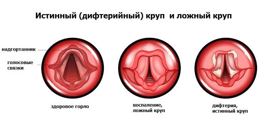 Дифтерия. причины, симптомы и лечение дифтерии.