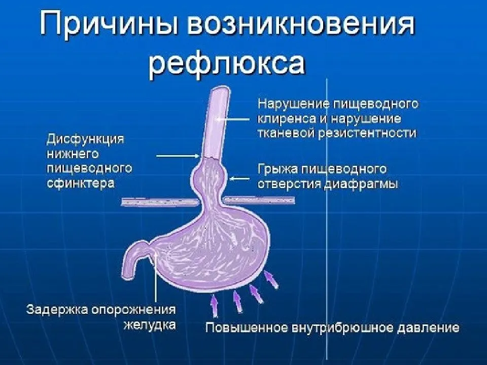 Гастроэзофагельная рефлюксная болезнь - что это