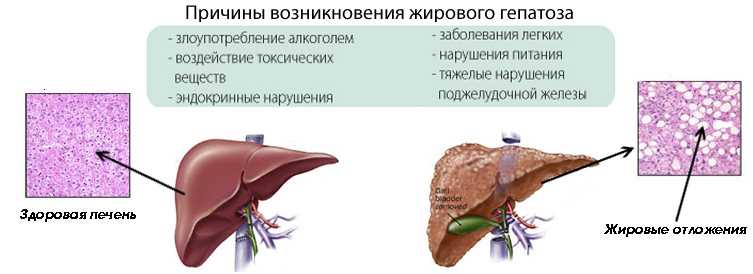 Защита печени: как предотвратить развитие заболеваний?